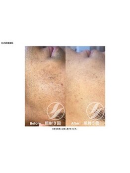 ダイアナ 出雲店(Daiana)/肌荒れへった