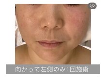 エラフリー/赤み/タルミ/むくみの改善(１回)