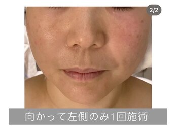 エラフリー/赤み/タルミ/むくみの改善(１回)