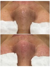 叶(Kanau)/毛穴エクストラクション1回