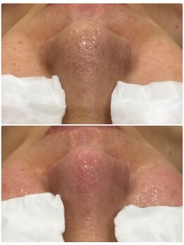 叶(Kanau)/毛穴エクストラクション1回