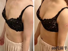 リール 新宿店(RIRE)/40代前半　バストアップ症例
