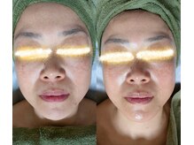 シエスタ 新小岩/小顔矯正と顔リンパ＆頭蓋骨調整