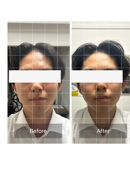 ダンニヒル(dannihil)/【小顔矯正】20代会社員初回