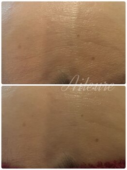 エルール トータルビューティ(Aileure total beauty)/ララピール×Waxフェイシャル