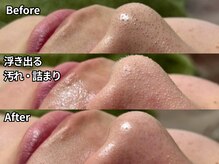 ピース(PEACE)の雰囲気（【浮かして溶かす毛穴角栓吸引】結果に驚く！ちゅるん毛穴に◎）