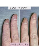 桃の木 吉祥寺店/代謝の悪い爪も改善！3