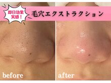 エステレア(Esthelea)/毛穴ケア〈毛穴集中コース〉