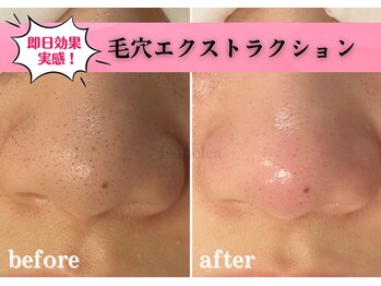 エステレア(Esthelea)/毛穴ケア〈毛穴集中コース〉