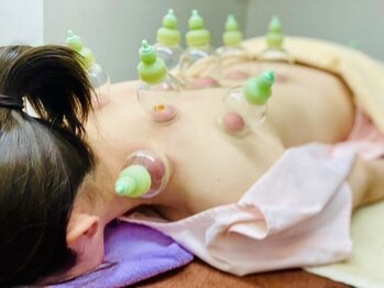 浅間口はりきゅう院の写真/<気温の変化による体調不良を解消!> 大人気カッピングで血流改善◎ 背中の張りを緩めリラックス♪