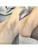 ヒスイ バイ アメイジング(Hisui by AMAZING)/【ワックス脱毛】男性脇　光脱毛