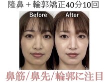 ラプリ 大阪心斎橋店(Raplit)/隆鼻＋輪郭矯正40分10回