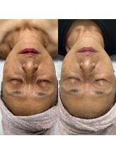 ウル(Ulu)/くすみたるみ改善