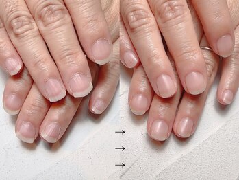 深爪矯正　自爪風