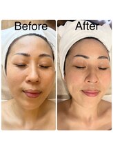 ミエル(miel)/毛穴洗浄/ホワイトニング