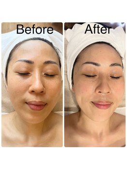 ミエル(miel)/毛穴洗浄/ホワイトニング