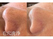 チョコバリ プラス(chocobari plus)/毛穴/黒ずみ/ハイドラ/開き毛穴