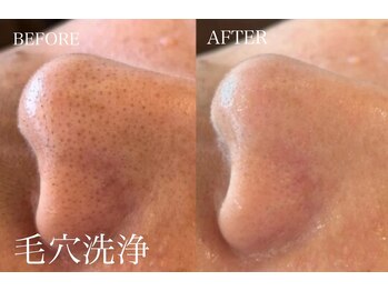 チョコバリ プラス(chocobari plus)/毛穴/黒ずみ/ハイドラ/開き毛穴