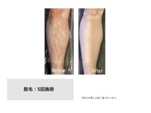 スタンド(STAND)/ひざ下脱毛 before after