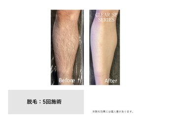 スタンド(STAND)/ひざ下脱毛 before after