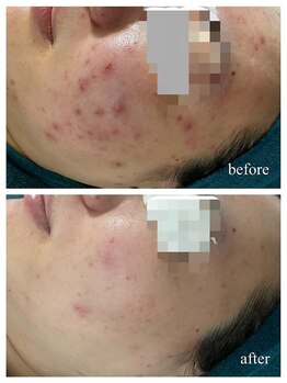 リノルーア(Linolua)/毛穴・ニキビケア・赤み改善♪