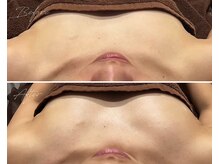 ローズドゥシャロン(Rose de CHALON)/【バストアップケアコース】