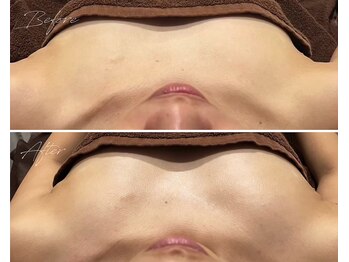 ローズドゥシャロン(Rose de CHALON)/【バストアップケアコース】