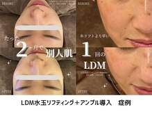 ルミエ 恵比寿店(Lumie)/LDM水玉リフティング症例
