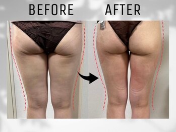 ネオン(Neon)/脂肪冷却