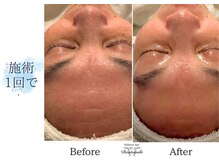 ディアスマイル(Dear.smile)/施術1回で