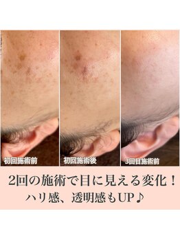 ルアナ(Luana)/【最新光フォト】シミ改善ケア
