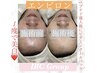 エンビロン：美白＋リフトUP・デコルテM＋パワープレート10分付