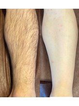 アレッド 大阪店(ared.)/夏までにツルツル肌を！