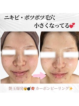 キー(kii)/カーボンピーリング