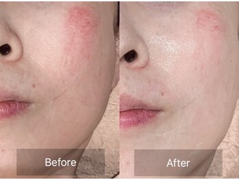 ハピエスト 御坊店/水光ピーリング