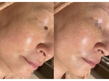 レーザーの戻りシミ改善の変化