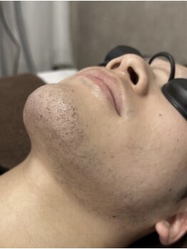 トータルビューティー ミミ(Total Beauty mimi)の写真/【大人の身だしなみ】メンズ脱毛で清潔感を格上げ！最新機器を使用し肌状態を見ながら丁寧に施術します♪
