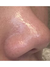 ユズドット(yuzu.)/黒ずみ.開き.ザラつき.角栓オフ