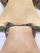 肌質改善専門【Salon da Mahina】毛穴ケア/ニキビケア/ハーブピーリング&nbsp;ボディ ピーリング