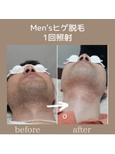 モーイ(mooi)/Men’s ヒゲ脱毛