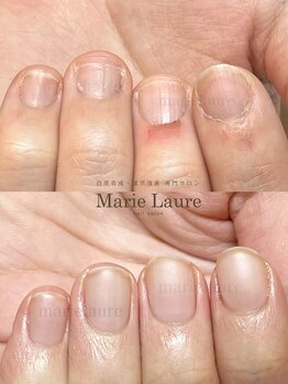 マリーロール 淀屋橋本店(Marie Laure)/自爪育成/深爪矯正/ネイルケア