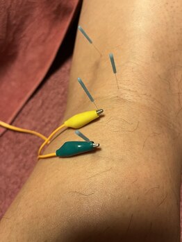 ライズ/膝の裏から脹脛への電気鍼