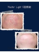 レオナルド(Leonardo)/ヒゲ照射4回