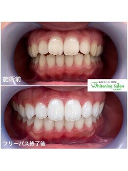 ホワイトニングサロン 名古屋駅店/【ホワイトニング施術例】