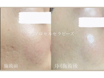 テテメルティ(te-te melty)/プロセルセラピーズ