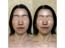 リフテグレース(LIFTE Grace)/光×テラボーラー