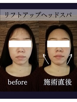ヘッドラボ(Headlabo★3103)/リフトアップヘッドスパ