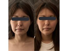 ハイコガオ(HIKOGAO)/小顔矯正60分