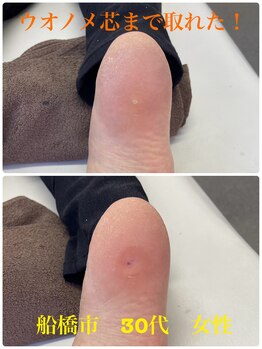 巻き爪じゅん 船橋店/ウオノメは芯まで取れますか？