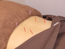 一樹鍼灸院の雰囲気（お辛い箇所にしっかり痛みを少なくアプローチを行なっていきます）